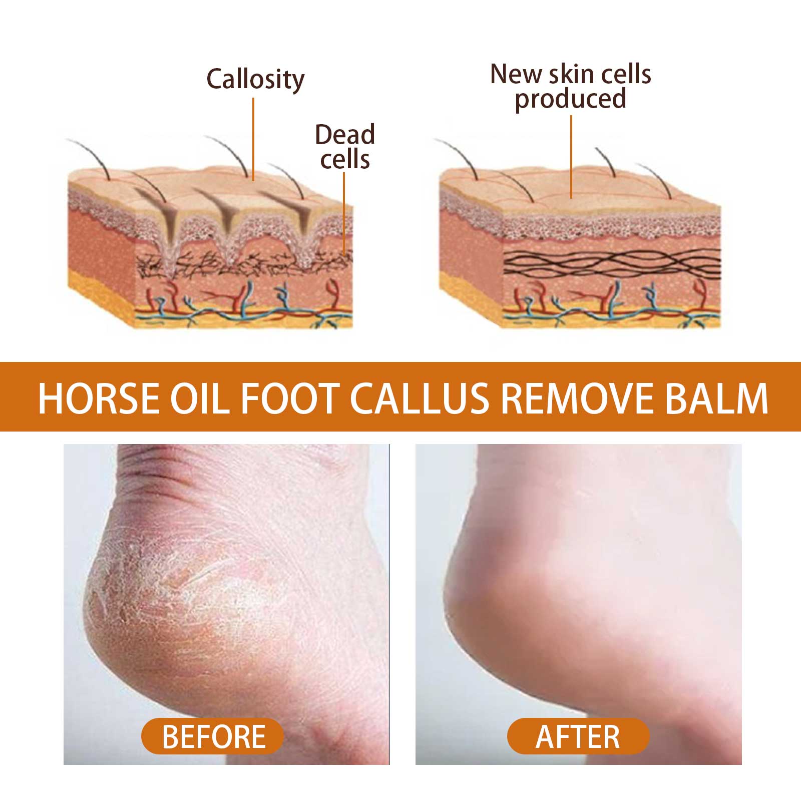 Foot Spray, Exfoliates Prevents Dry Cracking And Repairs Rough Skin Moisturizing Treatment Spray
