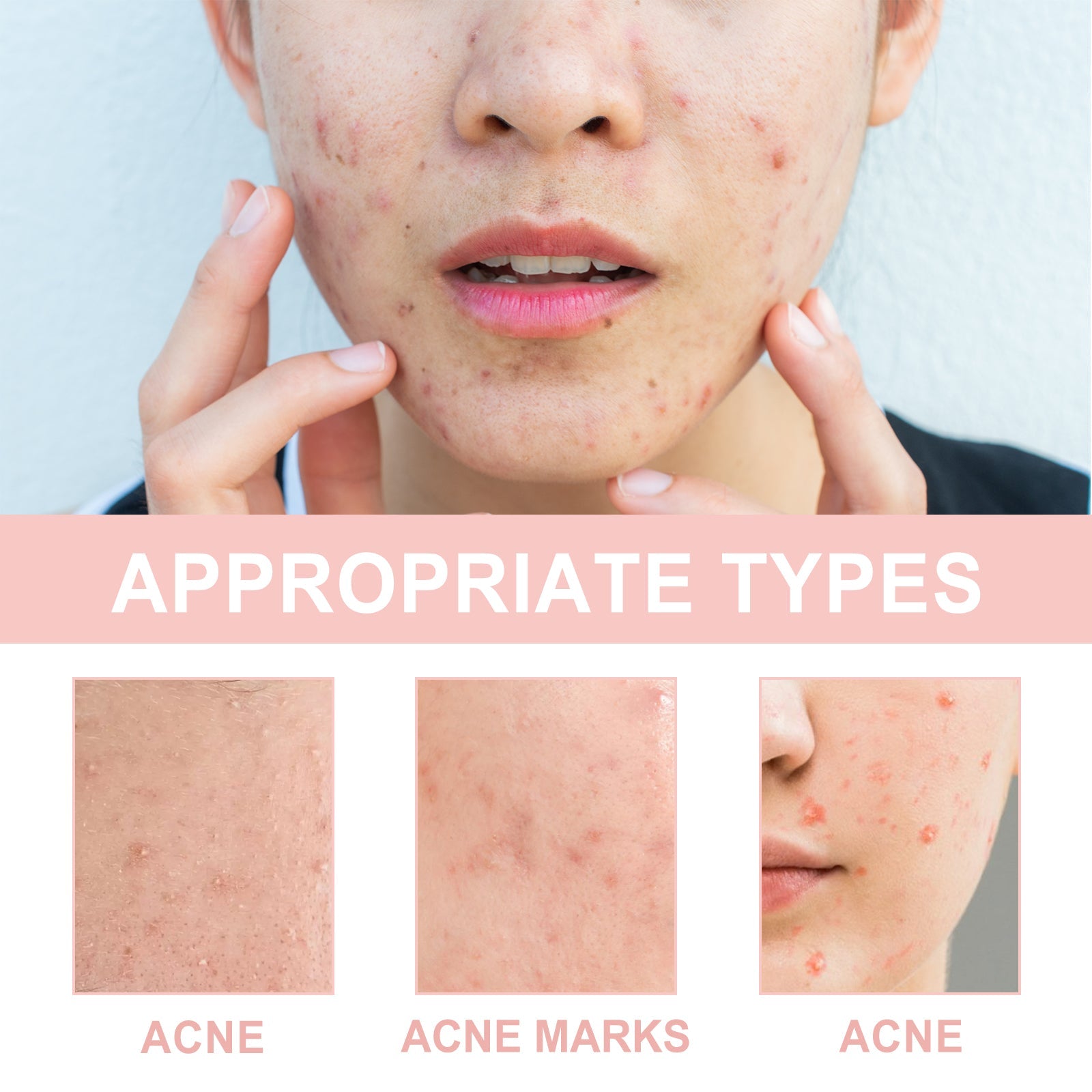 Acne Patch, Repair Acne Pimple Facial Redness Clean Pores Moisturize Skin Patch
